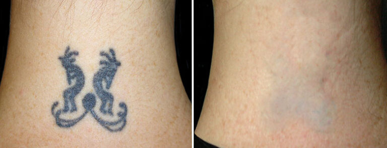 Better Tattoo Removal – Review